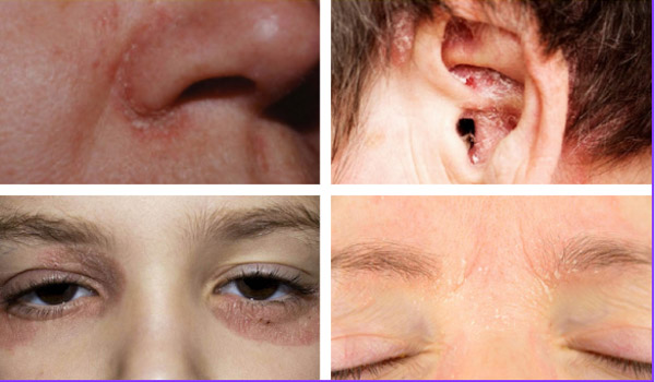 Triệu chứng vảy nến vùng da mặt thường đặc trưng bởi các vảy trắng nhỏ 
